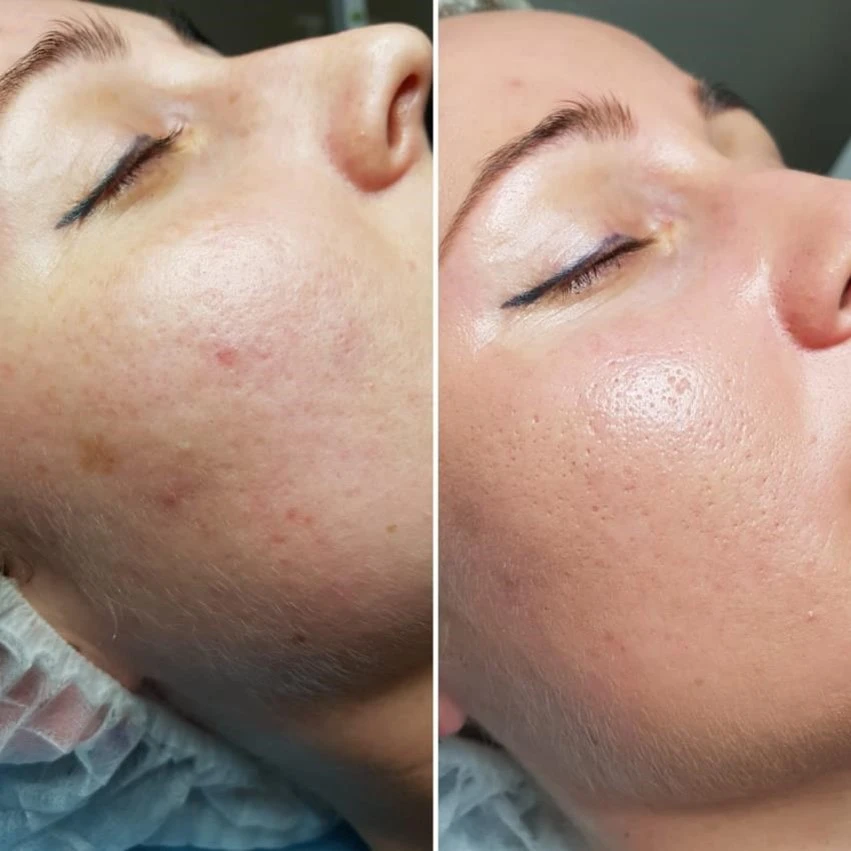 Green Peel Fresh Up Treatment - Before and After Results