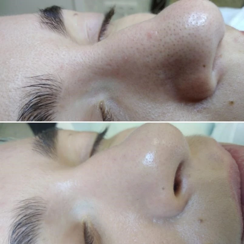 Green Peel Level 1 Detox - Before and After Results