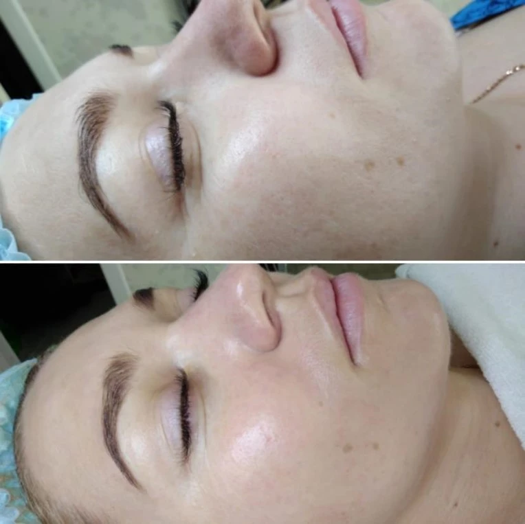 Green Peel Skin Detox Treatment - Before and After Results