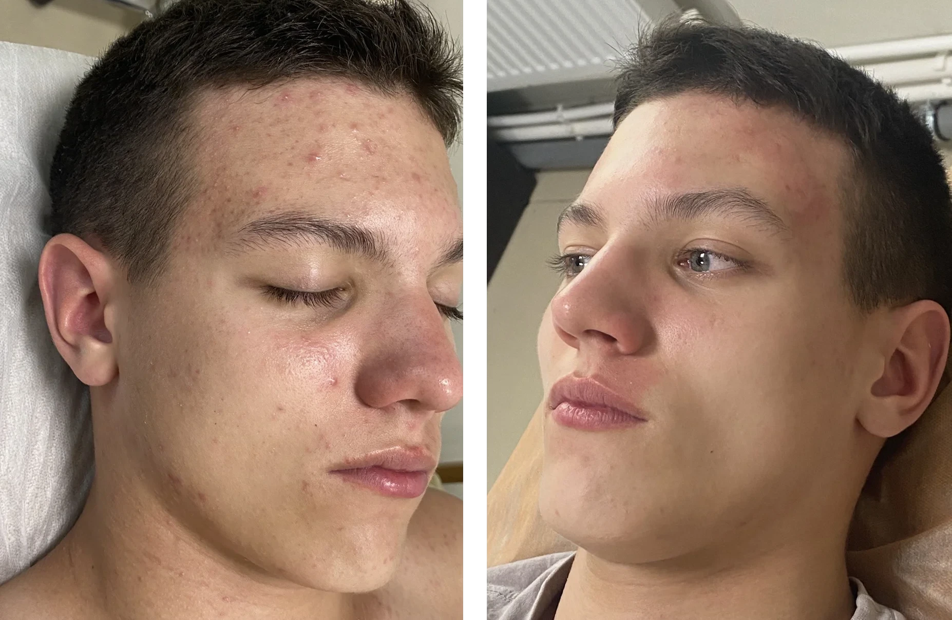 Green Peel Stop Acne Treatment - Before and After Results