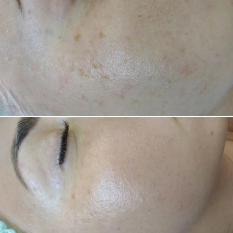 Green Peel Skin Brightening Treatment - Before and After Results
