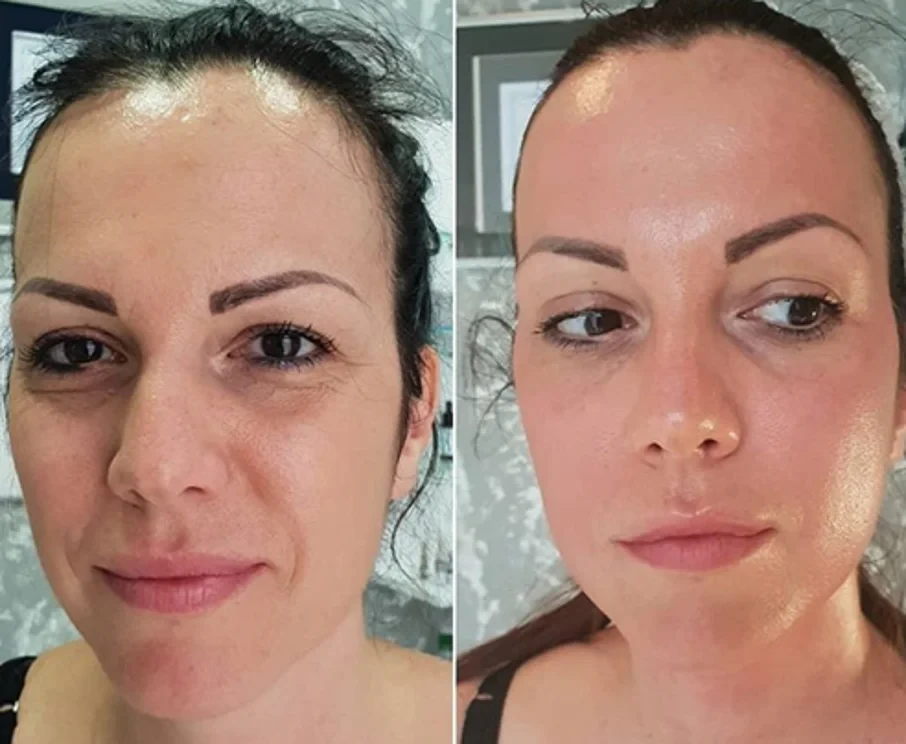 Green Peel Lift Intense Treatment - Before and After Results