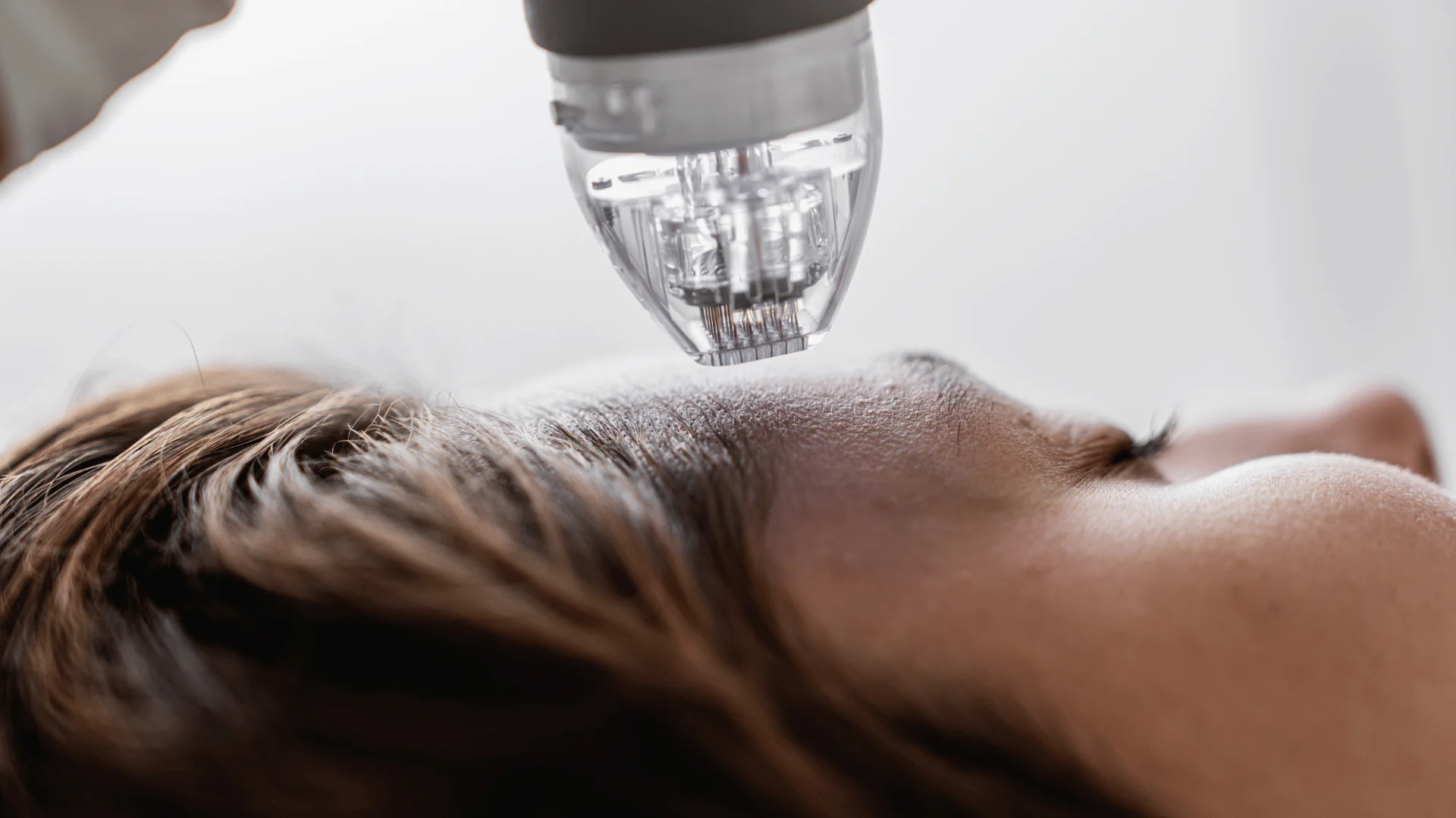 Microchanneling vs. Microneedling: Why the Difference Matters for Sensitive Skin