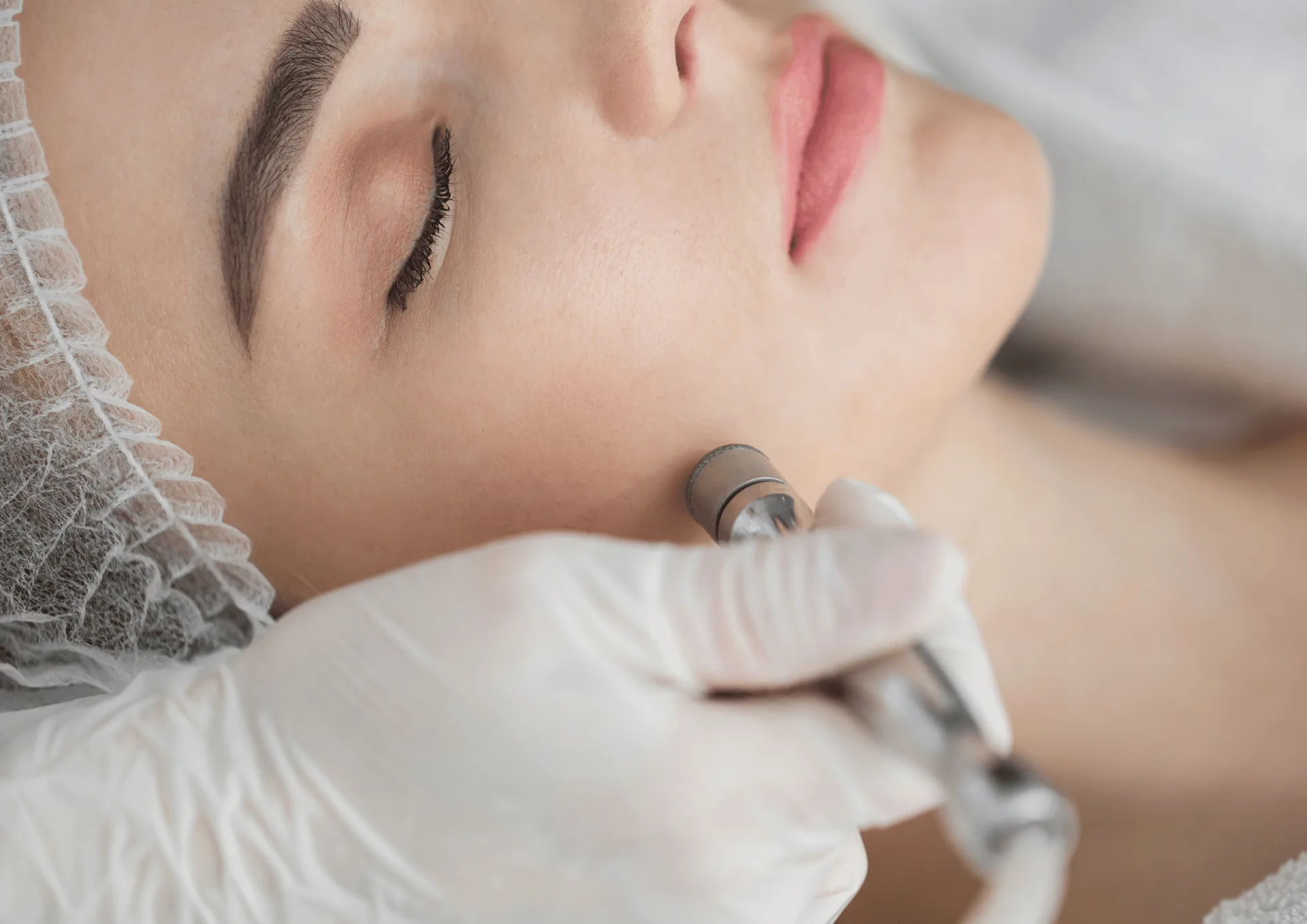 Microdermabrasion vs Chemical Peel: Which Treatment Is Right for Your Skin? A Toronto Esthetician's Guide